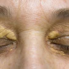 Image result for xanthelasma of eyelid
