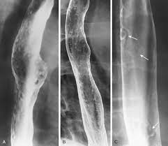 Healing and relapse of severe peptic esophagitis after treatment with omeprazole. Infectious Esophagitis Radiology Key
