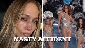 Jennifer Lopez suffers nasty face injury after accident