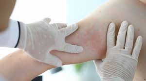 These droplets contaminate other people, objects and surfaces within the vicinity of the. Covid 19 Rashes How Your Skin Can Be A Sign Of The Virus Connect Fm Local News Radio Dubois Pa