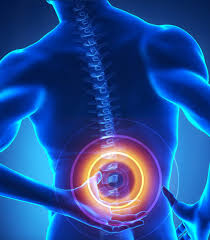 În general, discopatia lombară apare în urma unor traume fizice repetate şi a presiunii constante şi îndelungate exercitatea asupra coloanei vertabrale. ScapÄ De Hernia De Disc In Doar 20 De Minute