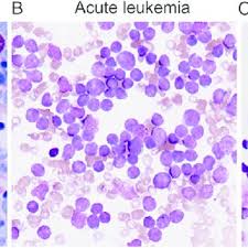 Bone marrow in acute leukemia and severe aplastic anemia. Normal bone...