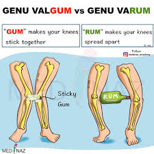 Image result for Genu Varum
