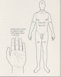 Use local anaesthetic for the unburned skin. Burns