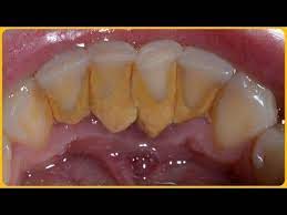 Properly rinse and store the toothbrush in an upright position until next use. How To Remove Dental Plaque In 5 Minutes Naturally Without Going To The Dentist Youtube Remove Tartar Deep Teeth Cleaning Tartar Removal