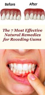 The 7 Most Effective Natural Remedies For Receding Gums Receding Gums Natural Remedies Remedies