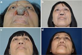 The nose is one of the smallest areas of the body to target with a laser, so it will also take a little time to get everything right. Laser Hair Removal Following Forehead Flap For Nasal Reconstruction Springerlink