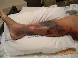 Clostridium perfringens (formerly known as c. Necrotizing Fasciitis Dermatology Medbullets Step 2 3