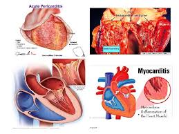 It can be caused by a variety of reasons. Acquired Heart Disease Ahd Rheumatic Fever Rf Rheumatic