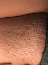 We did not find results for: Am I Supposed To Get Ingrown Hair Coming Out Two Days After First Session For Brazilian Hair Removal Photo