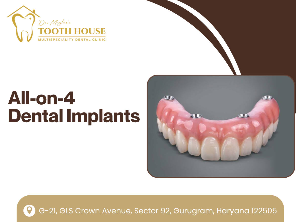 All-on-4 Dental Implants product image