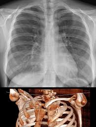 The right and left sides of the heart are further divided into: How Common Are Congenital Rib Abnormalities Pediatriceducation Org