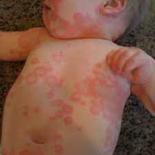 Multor bebeluși le apar pe piele bubițe de la căldură. Simptome De Alergie La Copii Care Ar Trebui Sa Ne Atraga Atentia