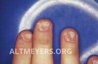 Image result for Koilonychia feet