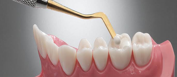 Tooth Filling (Composite Filling) product image
