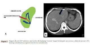 Collateral Pathways In Budd Chiari Syndrome Mdct Depiction Insight Medical Publishing