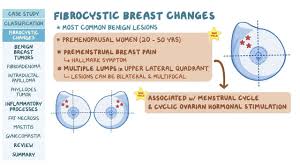 Mammary tissues represent a unique feature of the mammalian. Benign Breast Conditions Pathology Review Osmosis