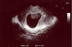 What To Expect When You Re 9 Weeks Pregnant Momtricks