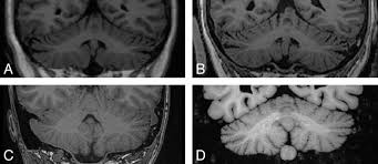 Image result for Essential Tremor