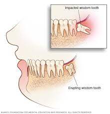 However, you may also feel no pain at all. Impacted Wisdom Teeth Symptoms And Causes Mayo Clinic