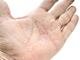 Does putting clothes in the dryer kill ringworm? Psoriasis Or Ringworm Symptoms Treatment And Other Rashes