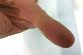 Image result for yellow sac spider bite skin