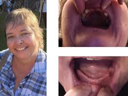 Fundraiser for Lesley Manton by Maddy Oliver : Help Lesley Smile Again With  Life-changing Surgery