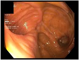 Image result for Neutropenic Colitis