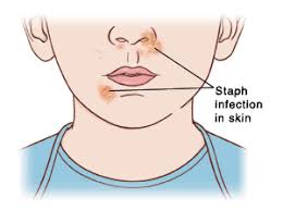 Staph and mrsa often cause itchy, painful skin infections, but internal infections are common too. Staph Infection Non Mrsa