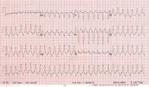 Ecg Rv Vt Ventricular Tachycardia Medical Textbooks Emergency Medicine Ekg Interpretation