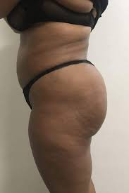 Il s'agit de la réinjection de la propre graisse du patient au niveau des fesses. Implant Fessier Paris Chirurgien Esthetique Paris 16 Essonne