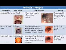 Congenital esophageal stenosis, corrugated ringed esophagus, and eosinophilic esophagitis. 2 Infectious Esophagitis Youtube