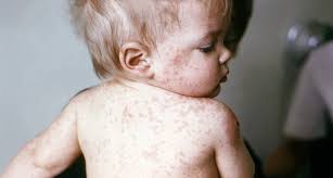U.S. outbreak of measles emerges