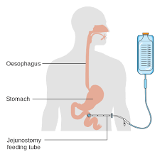 Indikation bei mobilen und aktiven patienten zum besseren handling und aus kosmetischen gründen. Perkutane Endoskopische Gastrostomie Wikiwand