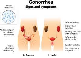 Gonorrhea symptoms in women can include abnormal vaginal discharge—particularly a watery, creamy, or slightly green discharge. Gonorrhea In Pregnancy American Pregnancy Association
