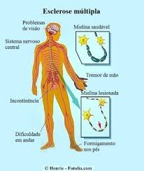 A esclerose múltipla é uma doença de origem autoimune, na qual o nosso organismo produz inapropriadamente anticorpos contra estruturas dos nossos nervos. Tipos De Esclerose Multipla E Causas Fisioterapia Para Todos