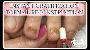 Pedicure Tutorial Toenail Fungus Reconstruction Pedisafe Gel Youtube Pedicure Tutorial Toe Nails Toenail Fungus