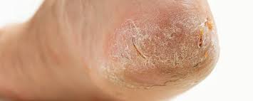 Image result for psoriasis