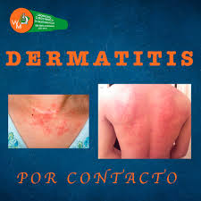 Image result for dermatitis contacta
