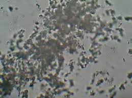 Ce processus peut provoquer de crises de goutte douloureuses. Cristaux Urates Amorphes Urines Urate Crystals In Urine