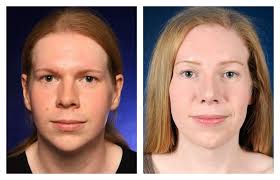 Juvederm Eyes Before After Photos Facial Feminization Surgery Cosmetic Surgery Financing Cosmetic Surgery