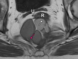 Anatomy of the abdomen and male pelvis using cross sectional imaging ct interactive atlas of human anatomy we have created an anatomical atlas of abdominal and pelvic ct which is an interactive tool for studying the conventional anatomy of the normal structures based on a multidetector. Mri Of Tumors And Tumor Mimics In The Female Pelvis Anatomic Pelvic Space Based Approach Radiographics