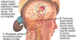 Nasal Endoscopy Dx Sinus Infection Google Search Migraine Headaches Headache Treatment Migraine