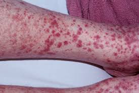 If you have tiny red, purple, or brown spots on. Henoch Schonlein Purpura Causes Symptoms Prognosis Treatment