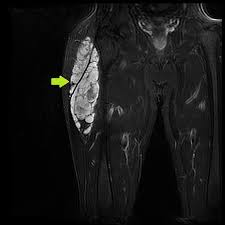 Image result for Chondrosarcoma