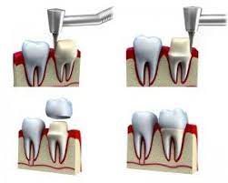 Dental Crown Procedure And Problems Coronas Dentales Tratamientos Dentales Implantes Dentales