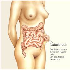 Nabelbruch Nabelhernie Ursachen Symptome Und Therapie