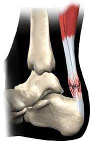 Il tendine di achille o tendine calcaneale è una terminazione fibrosa che collega il muscolo del polpaccio a all'osso posteriore del piede lo specialista del piede a roma che più si occupa di curare e prevenire queste patologie, compresa la rottura del tendine d'achille è il dr. La Rottura Del Tendine D Achille Cosa C E Da Sapere