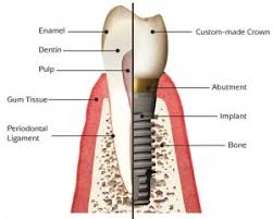 How much does wisdom teeth removal cost? Cost Of Getting Dental Implants In Mexico