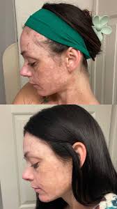 Starting weight loss journey with 60 days supply